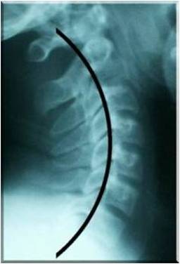 X Ray of healthy neck